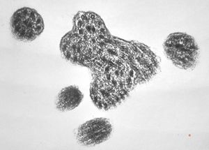 F,7y. | immotile cilia syndrome - nasal mucosa F,7y. | immotile cilia syndrome - nasal mucosa